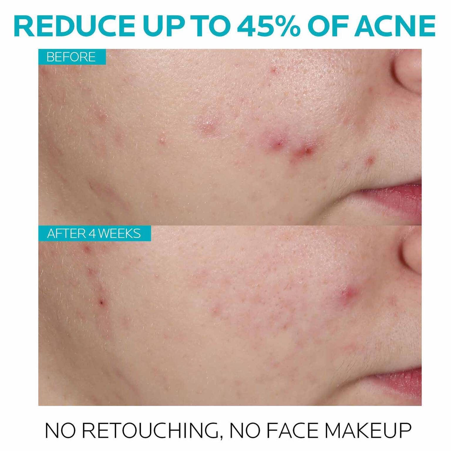 effaclar-salicylic-acid-acne-treatment-serum-y9 7_EffaclarSerum_After-45-days.jpg