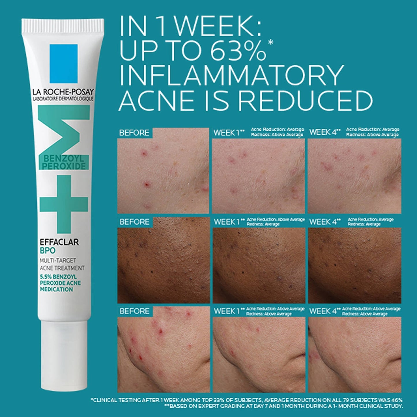 effaclar-bpo-multi-target-acne-treatment-with-5-5-benzoyl-peroxide-p5 EffaclarBPO-ClinicalBA-ATF-1500x1500-2.jpg