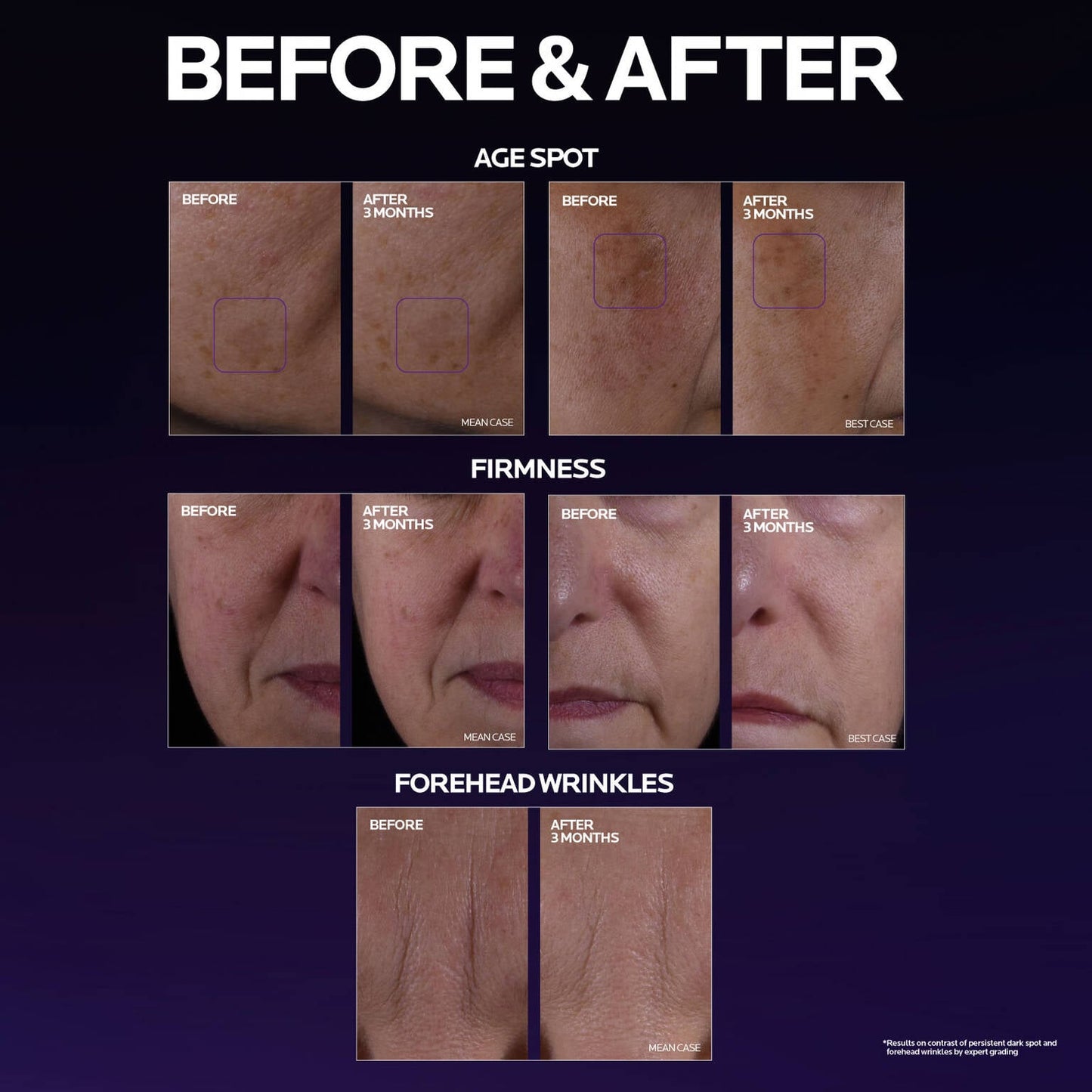 mela-b3-double-dose-discoloration-treatment-with-melasyltm-z7 MelaB3_DD_BTF_BeforeAfter_1500x1500_5.jpg
