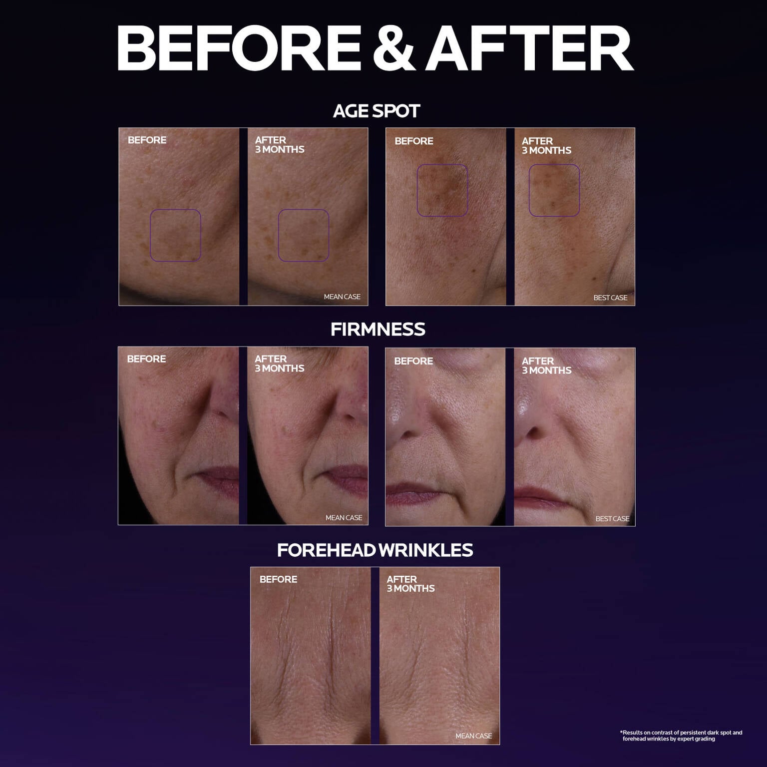 mela-b3-double-dose-discoloration-treatment-with-melasyltm-z7 MelaB3_DD_BTF_BeforeAfter_1500x1500_5.jpg
